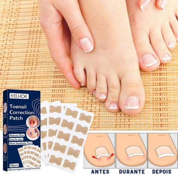 Adesivos para Correção e Tratamento de Unha Encravada do Dedo do Pé