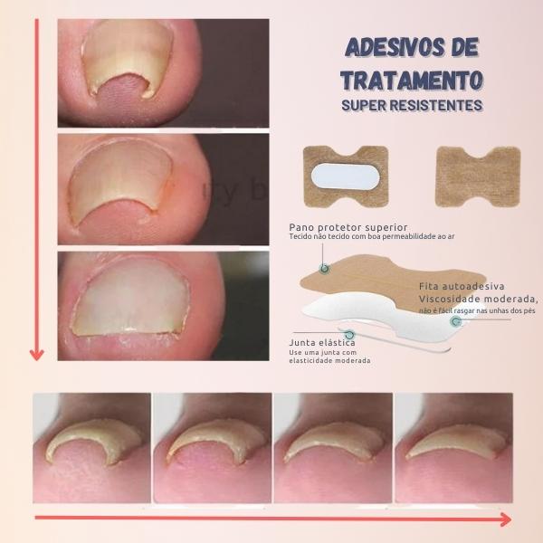 Adesivos para Correção e Tratamento de Unha Encravada do Dedo do Pé